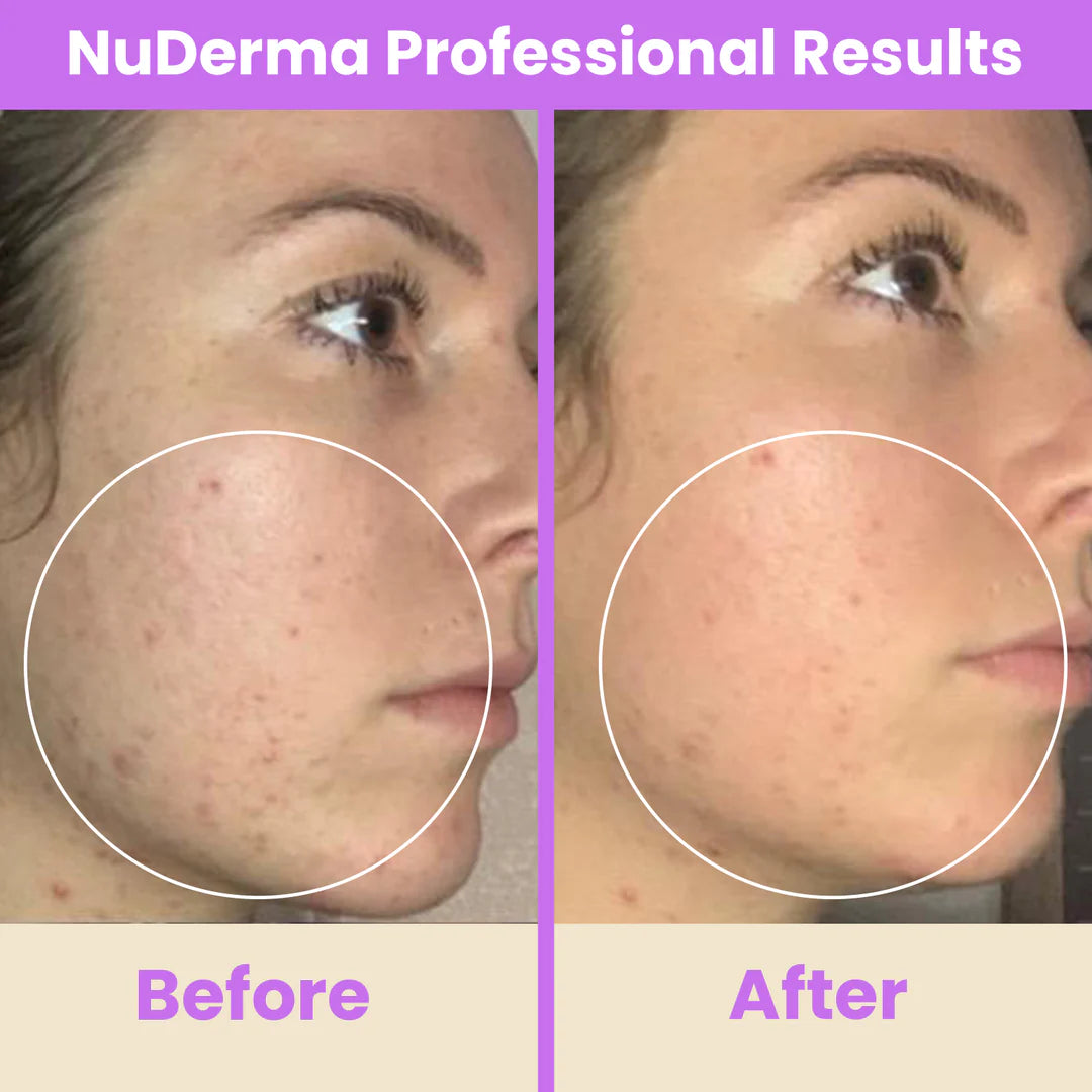 NuDerma™ Professional High Frequency Wand