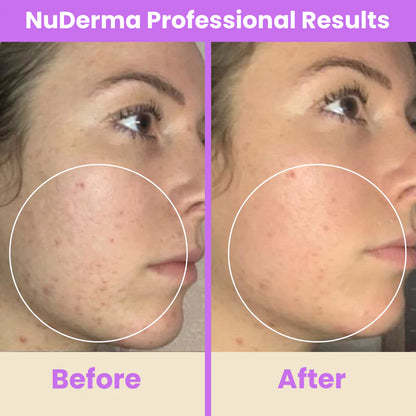 NuDerma™ Professional High Frequency Wand