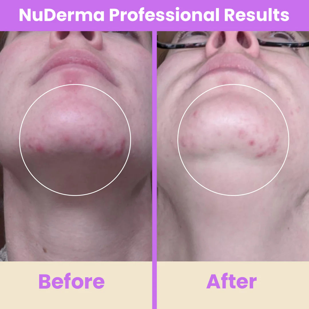 NuDerma™ Professional High Frequency Wand