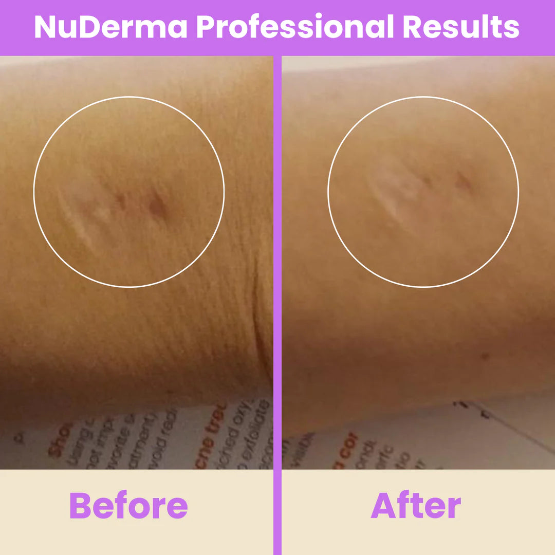 NuDerma™ Professional High Frequency Wand