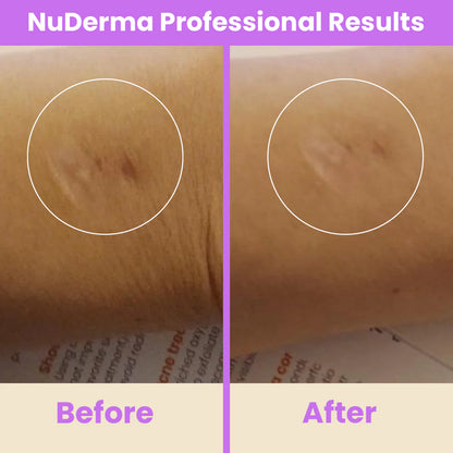 NuDerma™ Professional High Frequency Wand